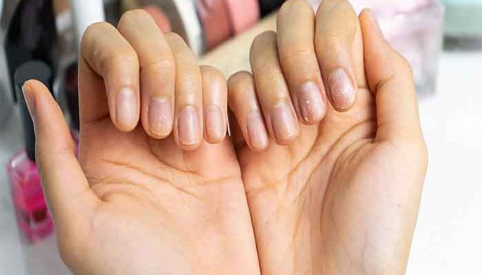 How to treat brittle nails?