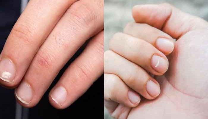 Where do white spots on nails come from?