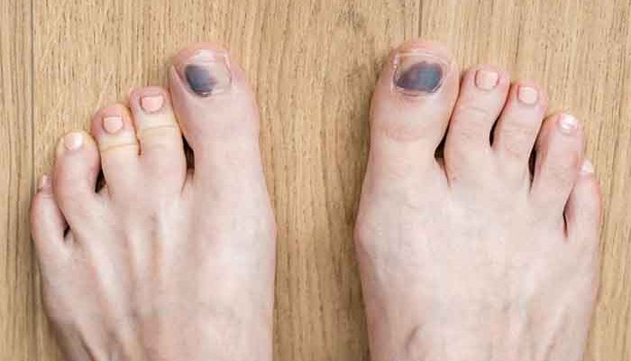 Tips to prevent black toenails