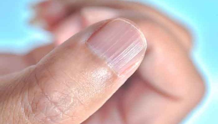 What to do when you have vertically cracked nails?