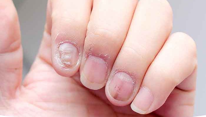 Causes of nail fungus