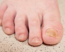 Yellowing of toenails: the different causes