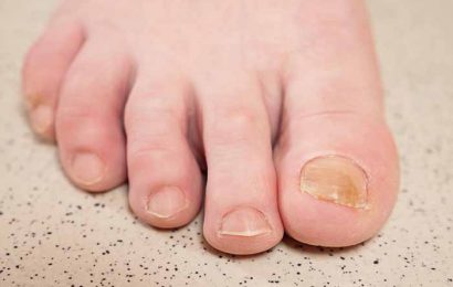 Yellowing of toenails: the different causes