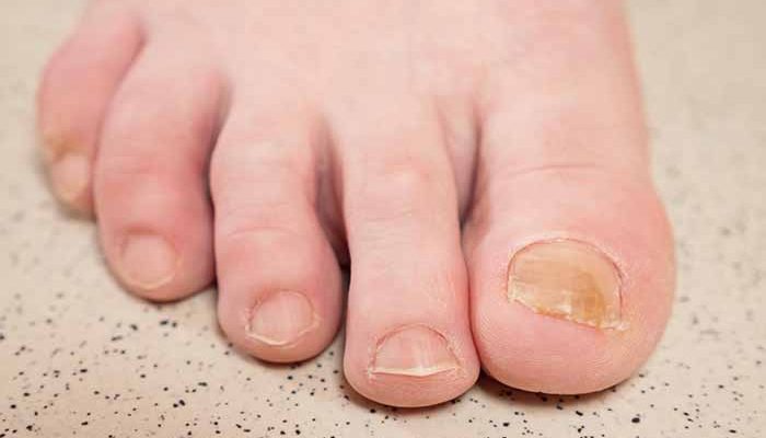 Yellowing of toenails: the different causes